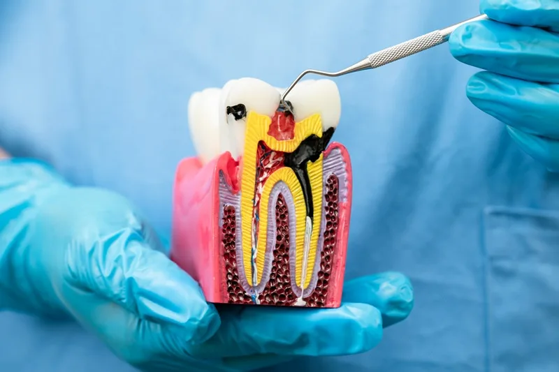 Endodoncia